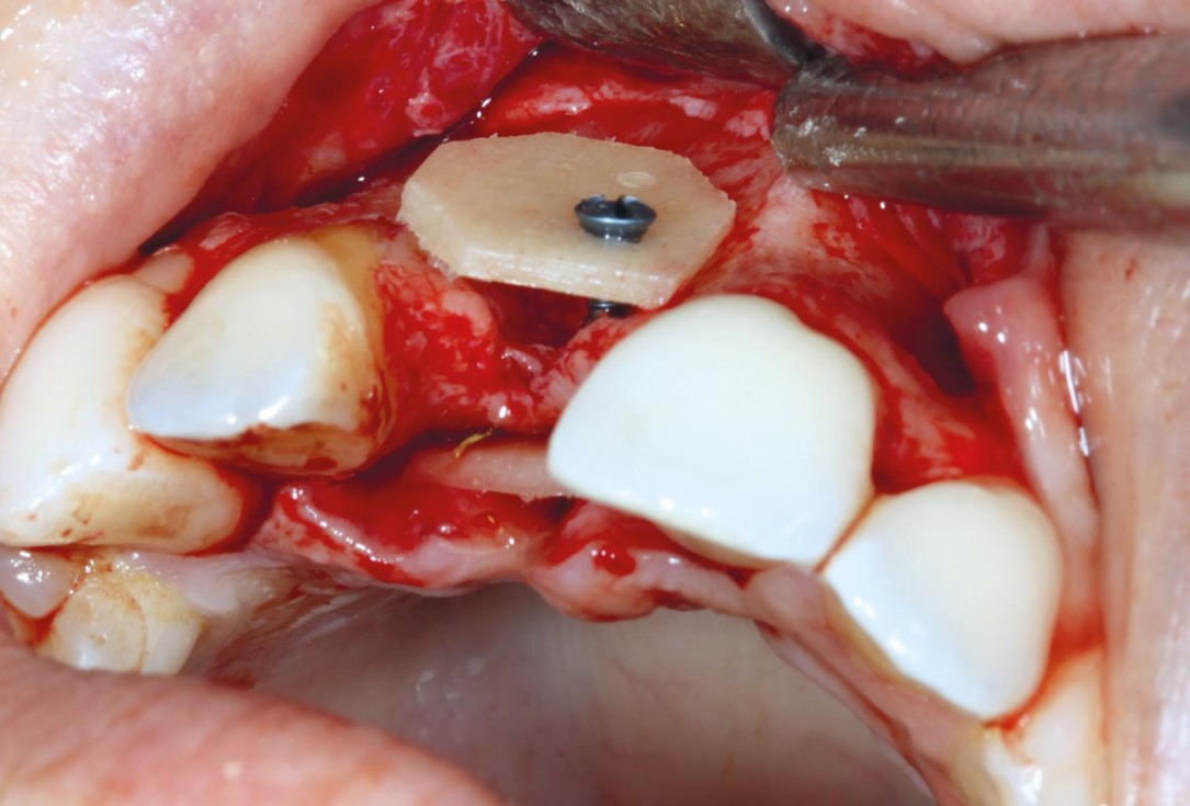 maxgraft® cortico at combined defect palatally and facially - Dr. K. Höckl