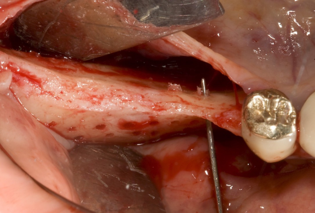 Ridge augmentation with maxgraft® bonebuilder - Dr. M. Jacotti