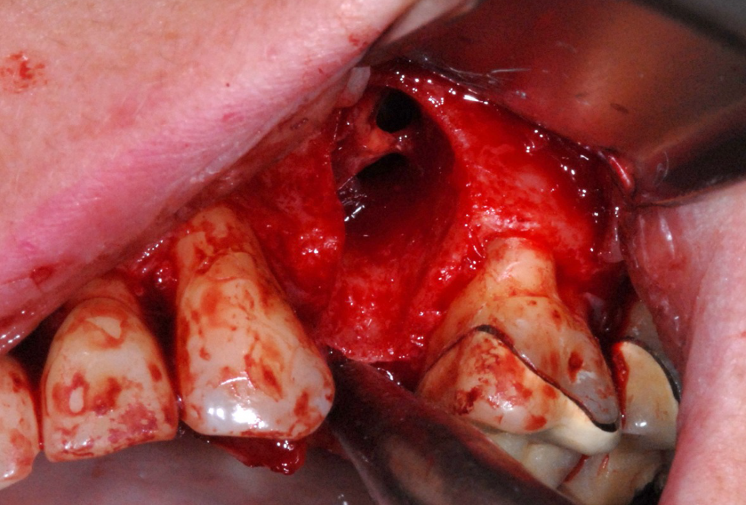 Ridge preservation with cerabone® and Jason® membrane - Dr. Derk Siebers