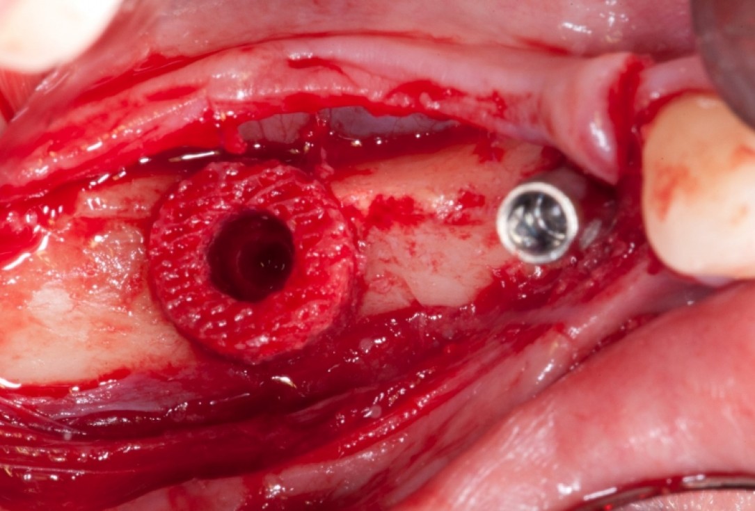 Vertical augmentation and sinus lift with maxgraft® bonering - Dr. O. Yüksel and Dr. B. Giesenhagen