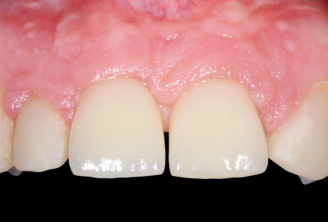 Ridge preservation with cerabone® Jason® membrane - Dr. D. Jelušić