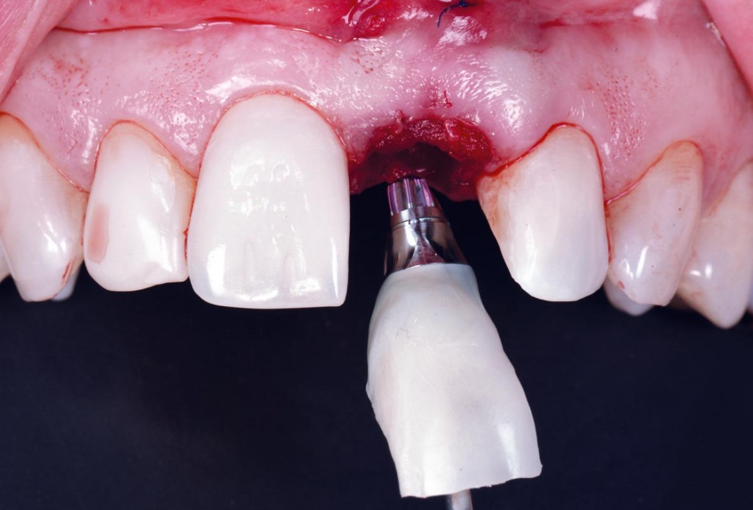 Excellent aesthetic result of buccal augmentation with mucoderm® and maxgraft® after immediate implant placement - 3-years follow-up - Dr. A. Puišys 