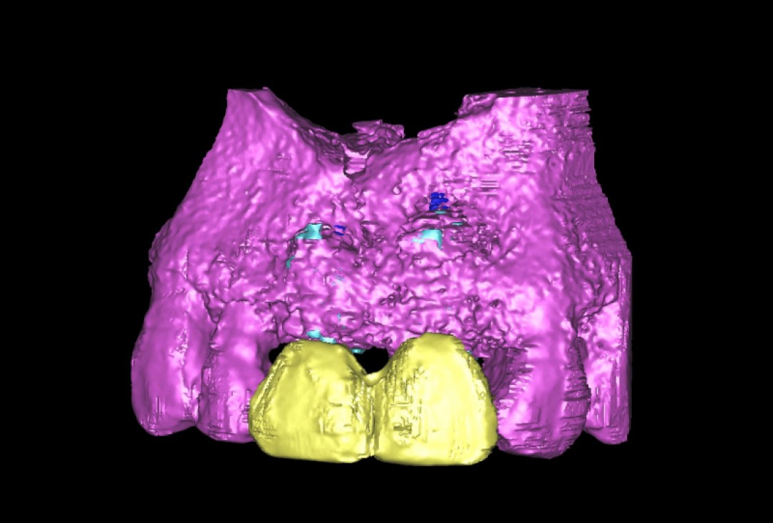 Ridge preservation with cerabone® Jason® membrane - Dr. D. Jelušić