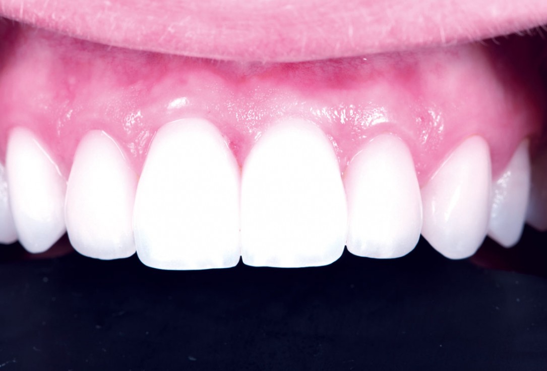 Excellent aesthetic result of buccal augmentation with mucoderm® and maxgraft® after immediate implant placement - 3-years follow-up - Dr. A. Puišys 