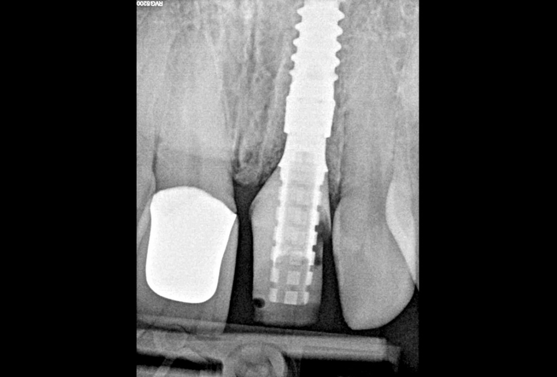Excellent aesthetic result of buccal augmentation with mucoderm® and maxgraft® after immediate implant placement - 3-years follow-up - Dr. A. Puišys 
