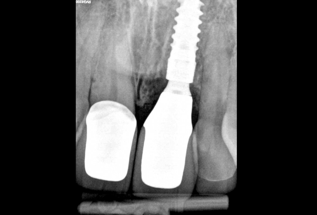 Excellent aesthetic result of buccal augmentation with mucoderm® and maxgraft® after immediate implant placement - 3-years follow-up - Dr. A. Puišys 