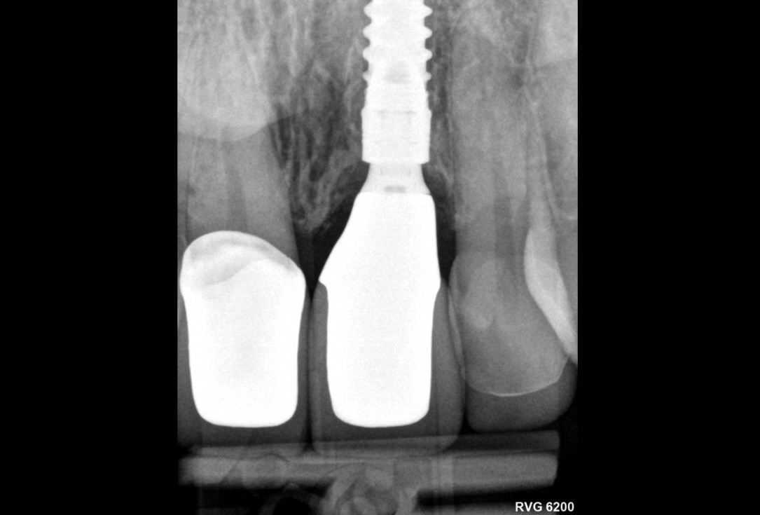 Excellent aesthetic result of buccal augmentation with mucoderm® and maxgraft® after immediate implant placement - 3-years follow-up - Dr. A. Puišys 