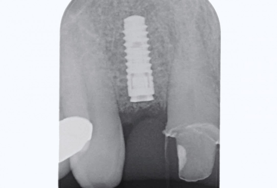 Bone augementation with maxresorb® - Dr. R. Cutts
