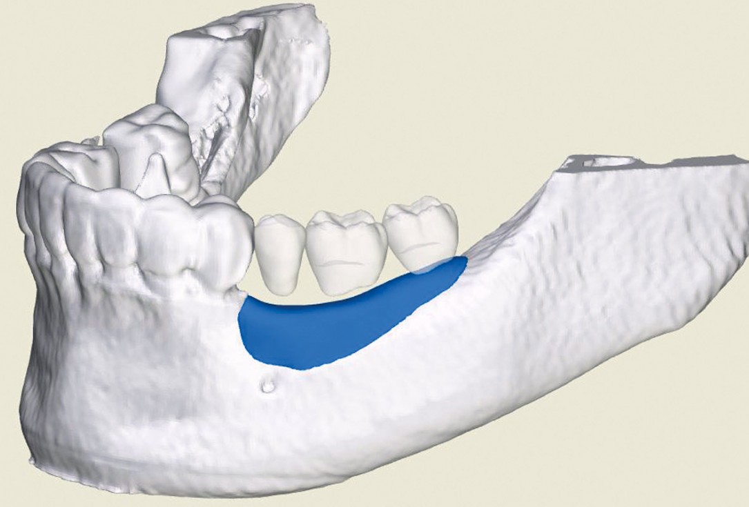 Ridge augmentation in the mandible with maxgraft® bonebuilder in a free-end situation - Dr. Dr. Dr. O. Blume