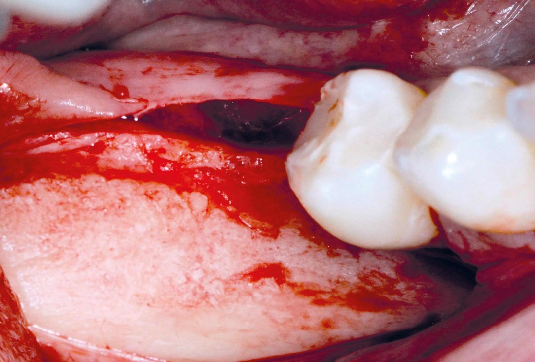 Ridge augmentation in the mandible with maxgraft® bonebuilder– Dr. R. Morger