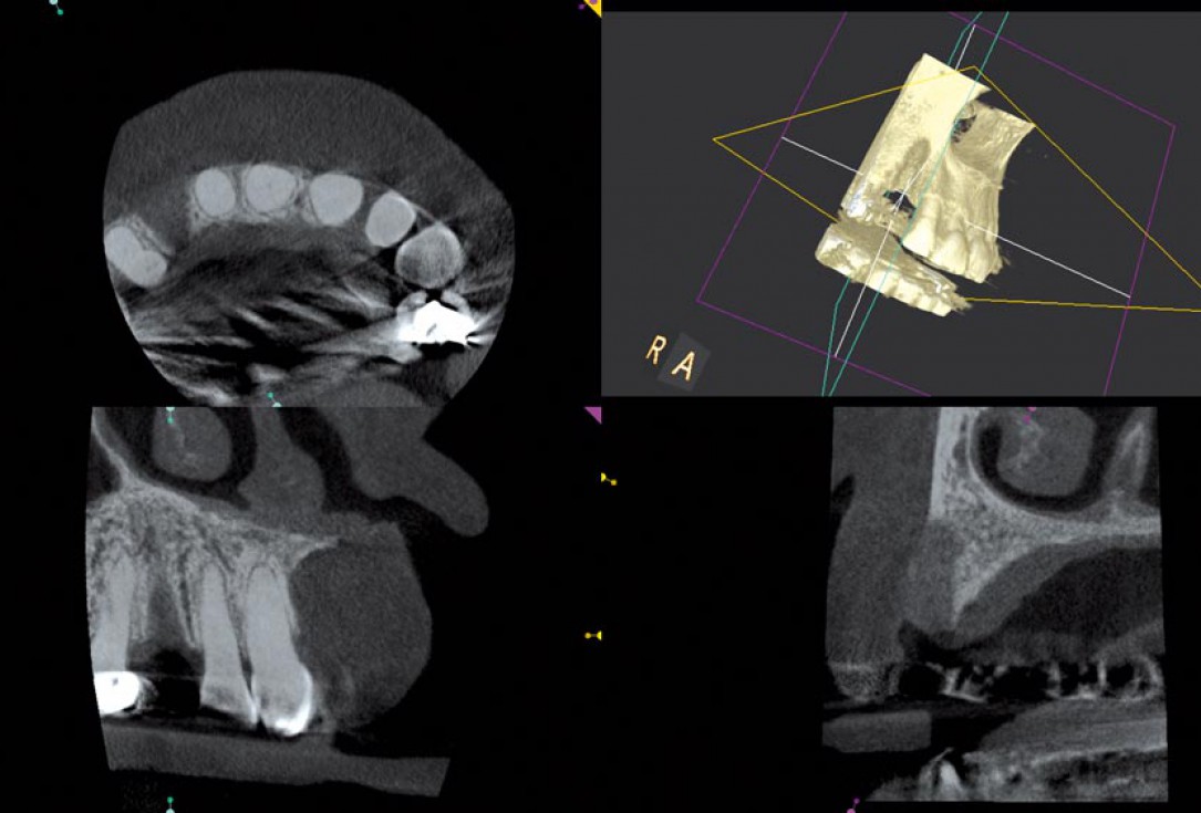 Block augmentation with maxgraft® in the maxilla - PD Dr. Dr. F. Kloss