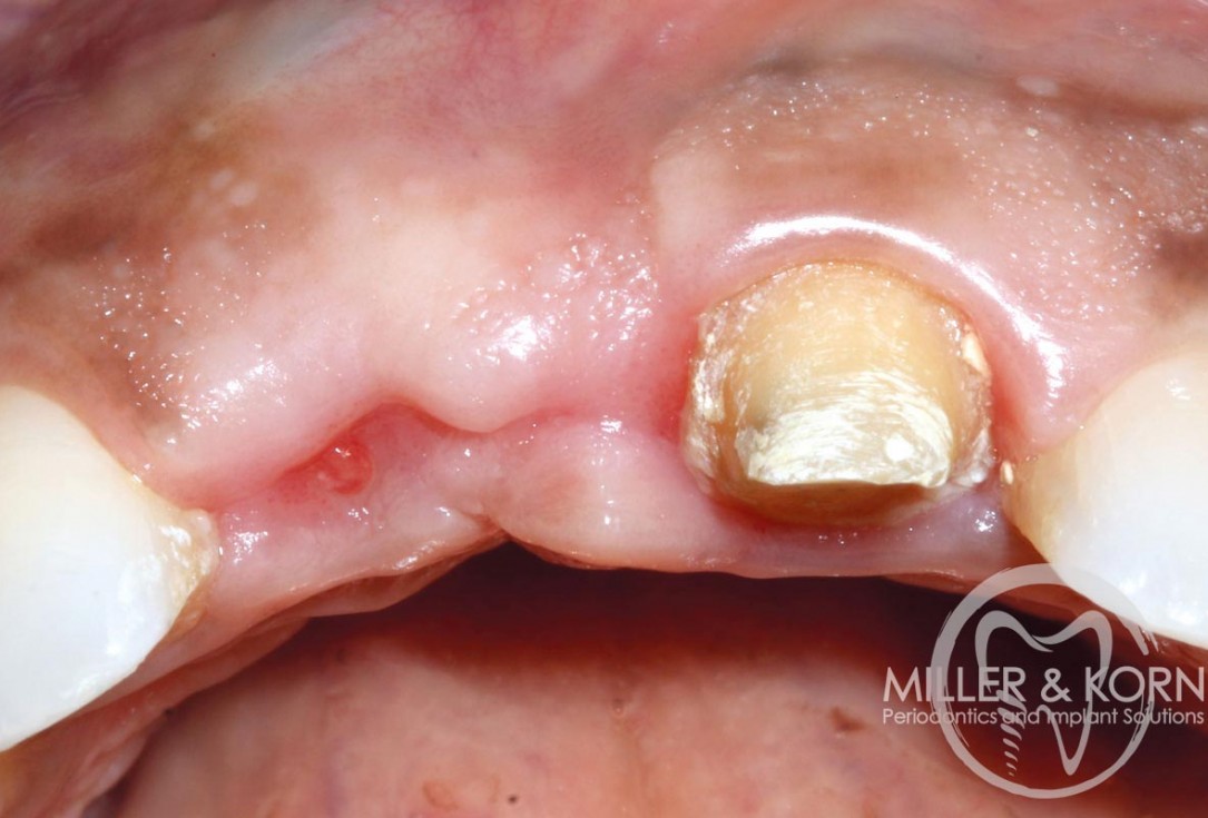 Immediate implant placement and regeneration of ridge using an allograft bone ring and Jason® membrane - Dr. Miller and Korn