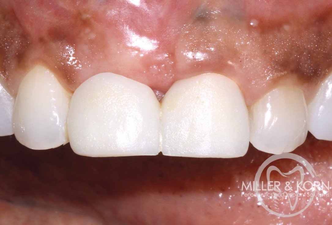 Immediate implant placement and regeneration of ridge using an allograft bone ring and Jason® membrane - Dr. Miller and Korn