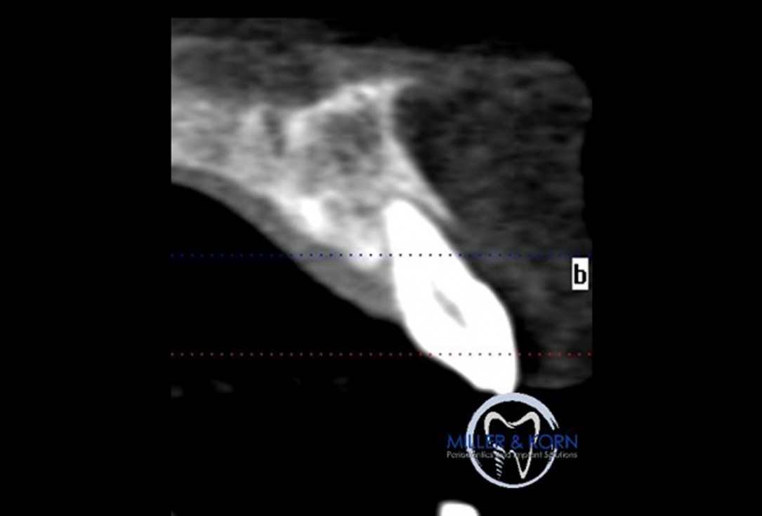 Immediate implant placement and correction of horizontal and vertical bone loss using an allograft bone ring, cerabone® and Jason® membrane - Drs. Miller and Korn