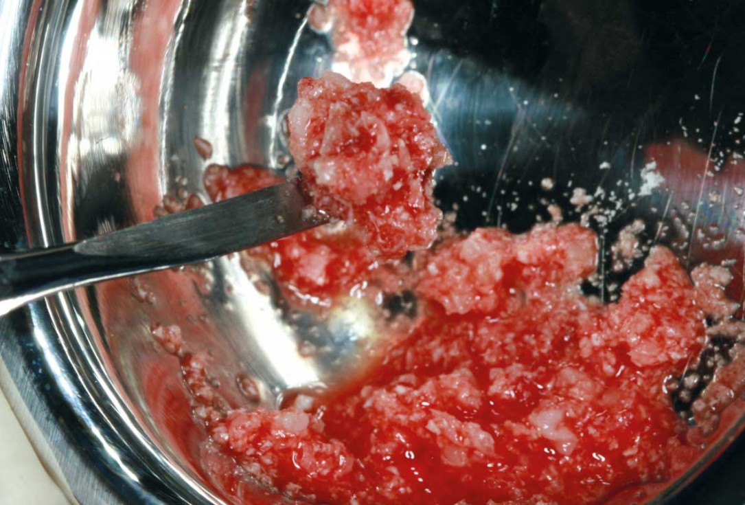 maxgraft® cortico at free-end situation in the mandible - J. Kielhorn