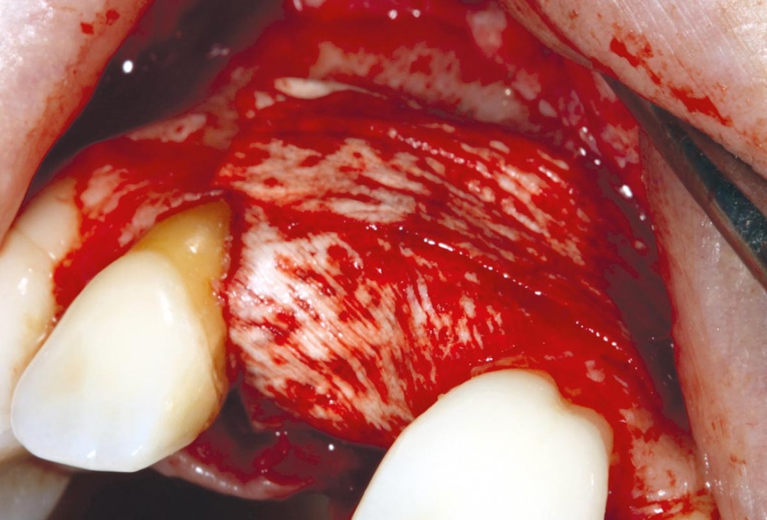 maxgraft® cortico at combined defect palatally and facially - Dr. K. Höckl