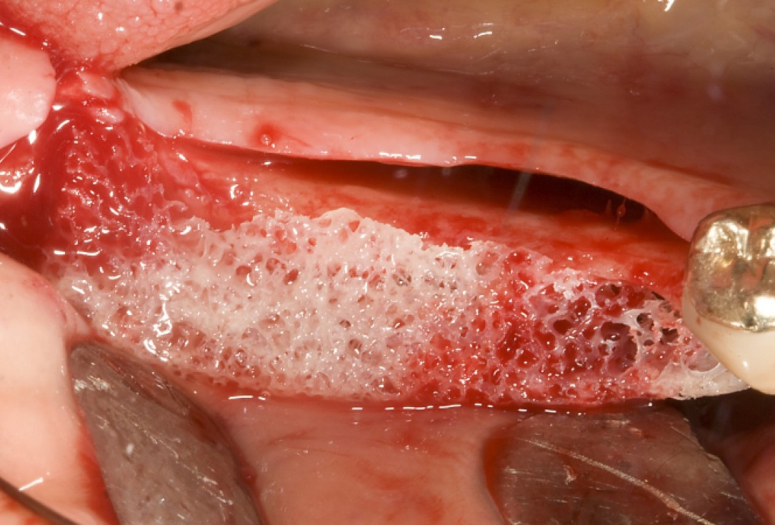 Ridge augmentation with maxgraft® bonebuilder - Dr. M. Jacotti