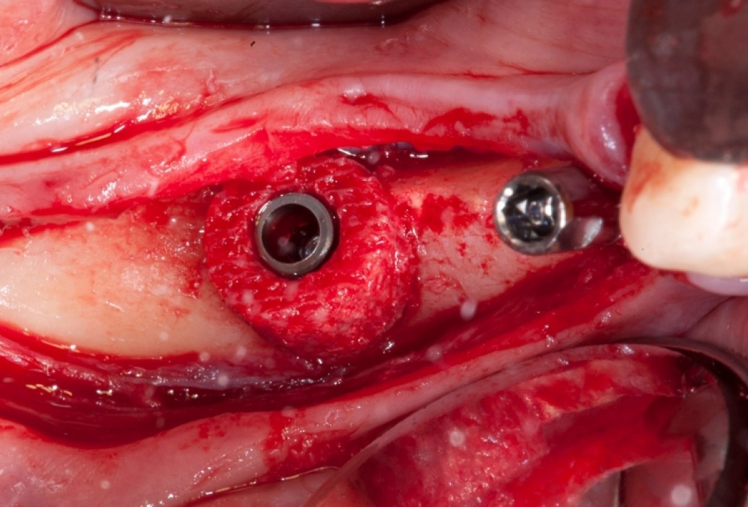 Vertical augmentation and sinus lift with maxgraft® bonering - Dr. O. Yüksel and Dr. B. Giesenhagen