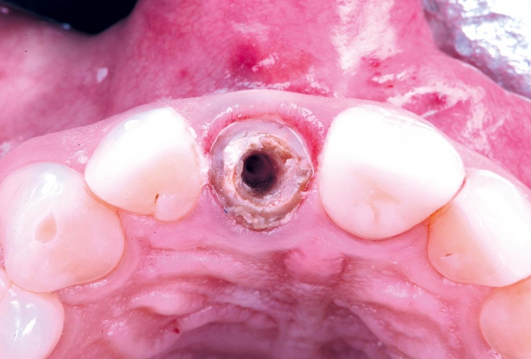 Excellent aesthetic result of buccal augmentation with mucoderm® and maxgraft® after immediate implant placement - 3-years follow-up - Dr. A. Puišys 