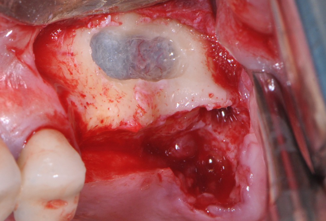 Sinus lift with simultaneous implantation with cerabone® and collprotect® membrane - clinical case Dr. Victor Kalenchuk