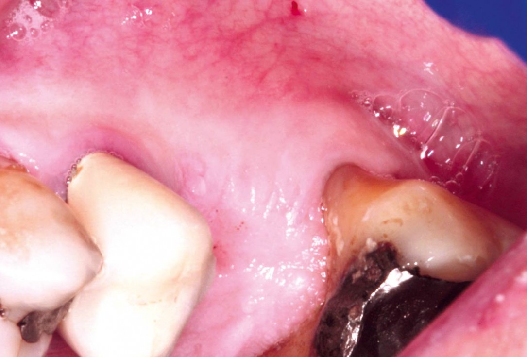 15/35 Maxillary sinus cyst removal using the Crocodile Technique and subsequent lateral sinus lift with cerabone®, maxgraft® and Jason® membrane - Dres. C. Scognamiglio and A. Perucchi