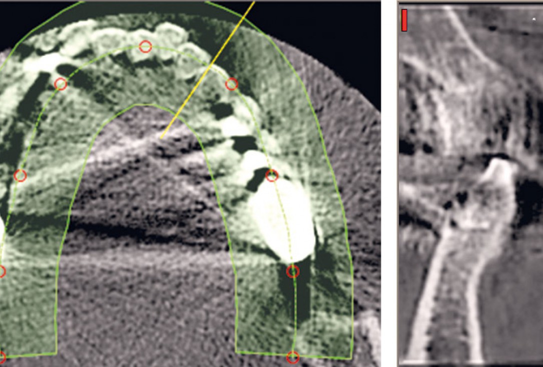 Three-dimensional augmentation with maxgraft® cortico - M.Sc. E. Kapogianni