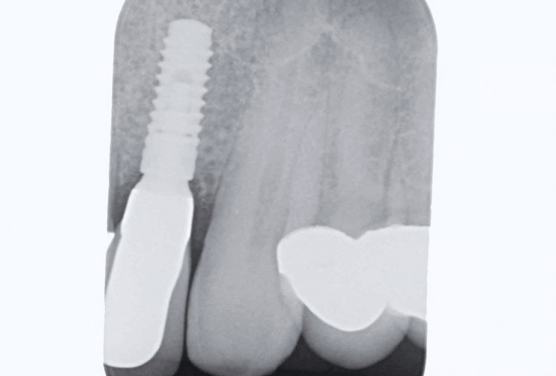 Bone augementation with maxresorb® - Dr. R. Cutts
