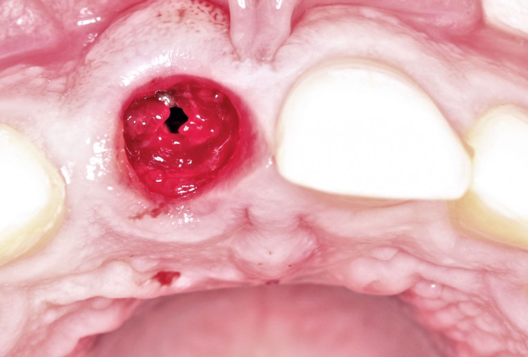 Type II socket defect grafted and repaired in a flapless way using Jason® membrane and maxgraft® cortico-cancellous - Dr. A. Jones
