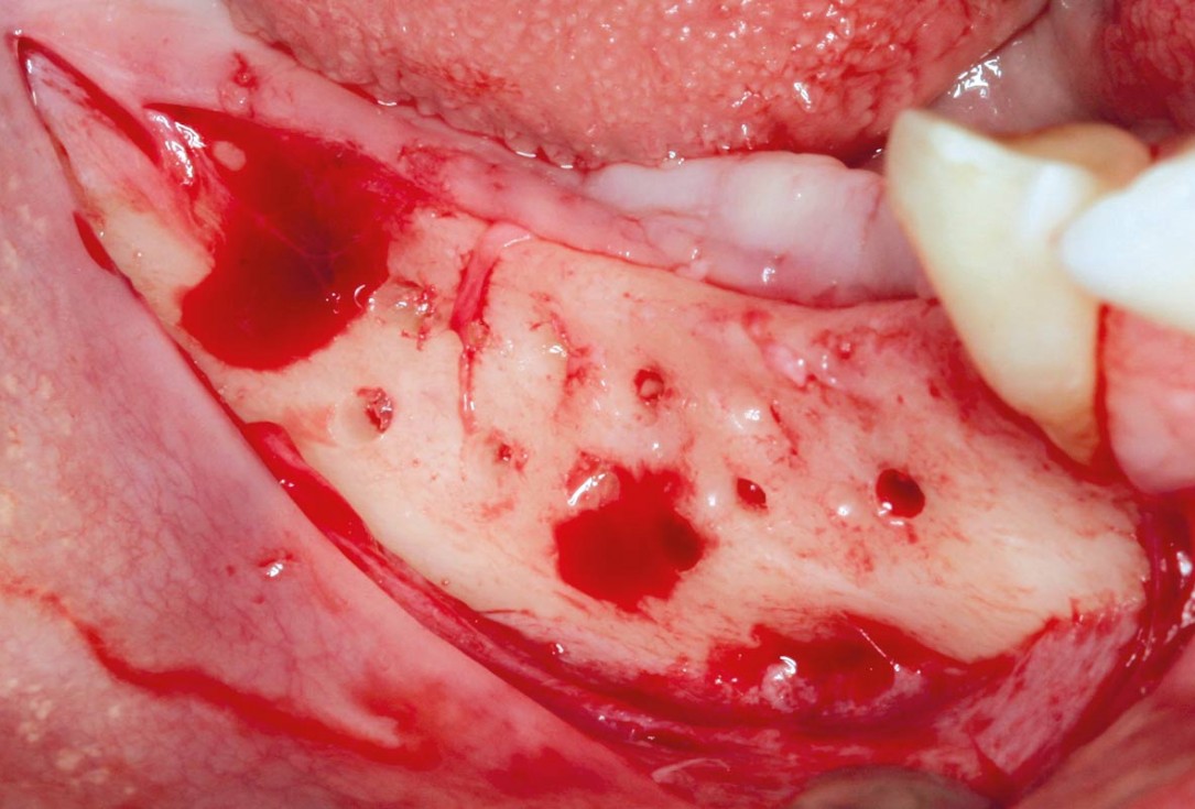 Horizontal ridge augmentation in the mandible with maxgraft® bonebuilder - Dr. O. Yüksel