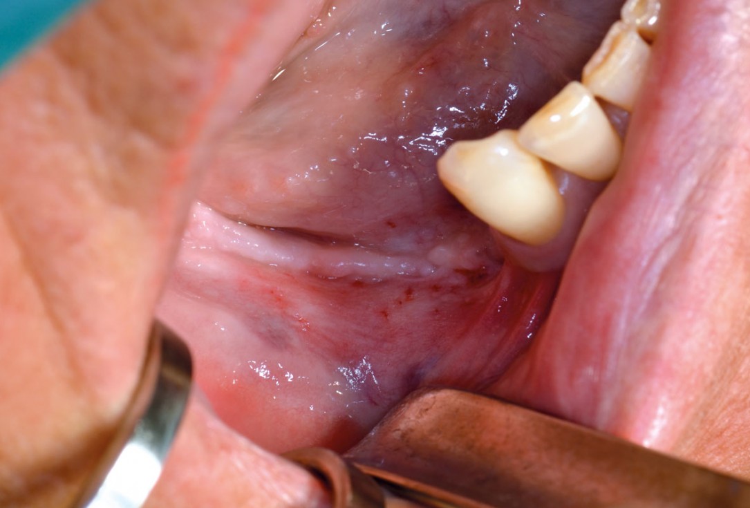 botiss maxgraft® bonebuilder for mandibular reconstruction - Clinical case