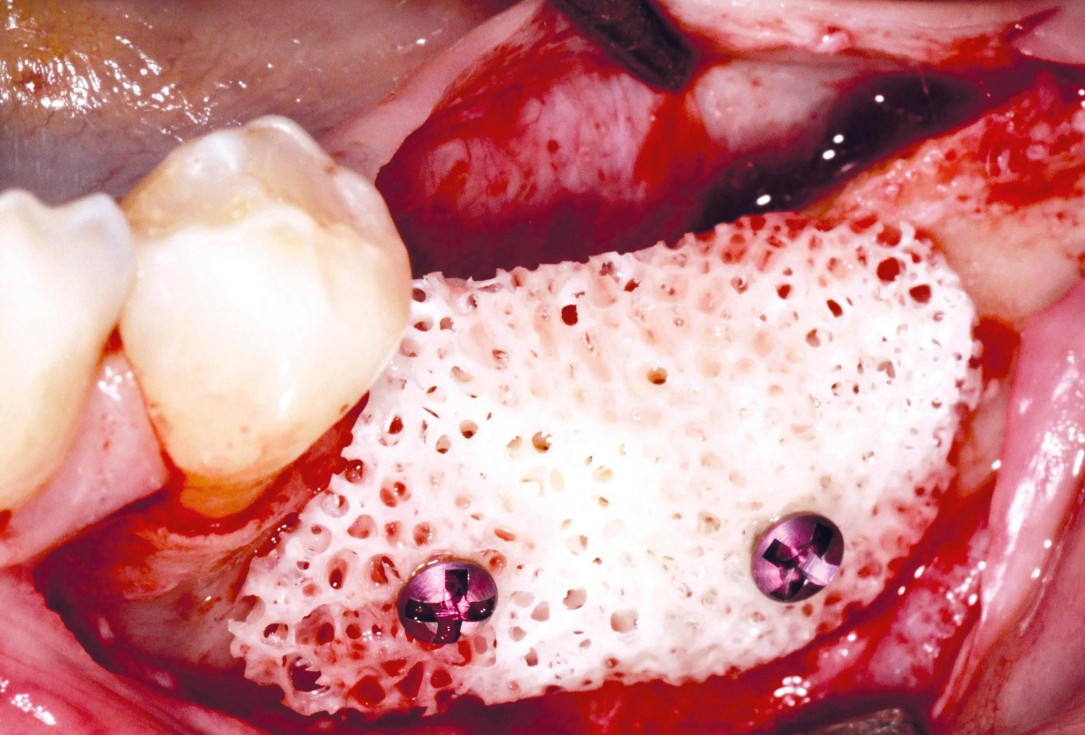 Ridge augmentation in the mandible with maxgraft® bonebuilder– Dr. R. Morger