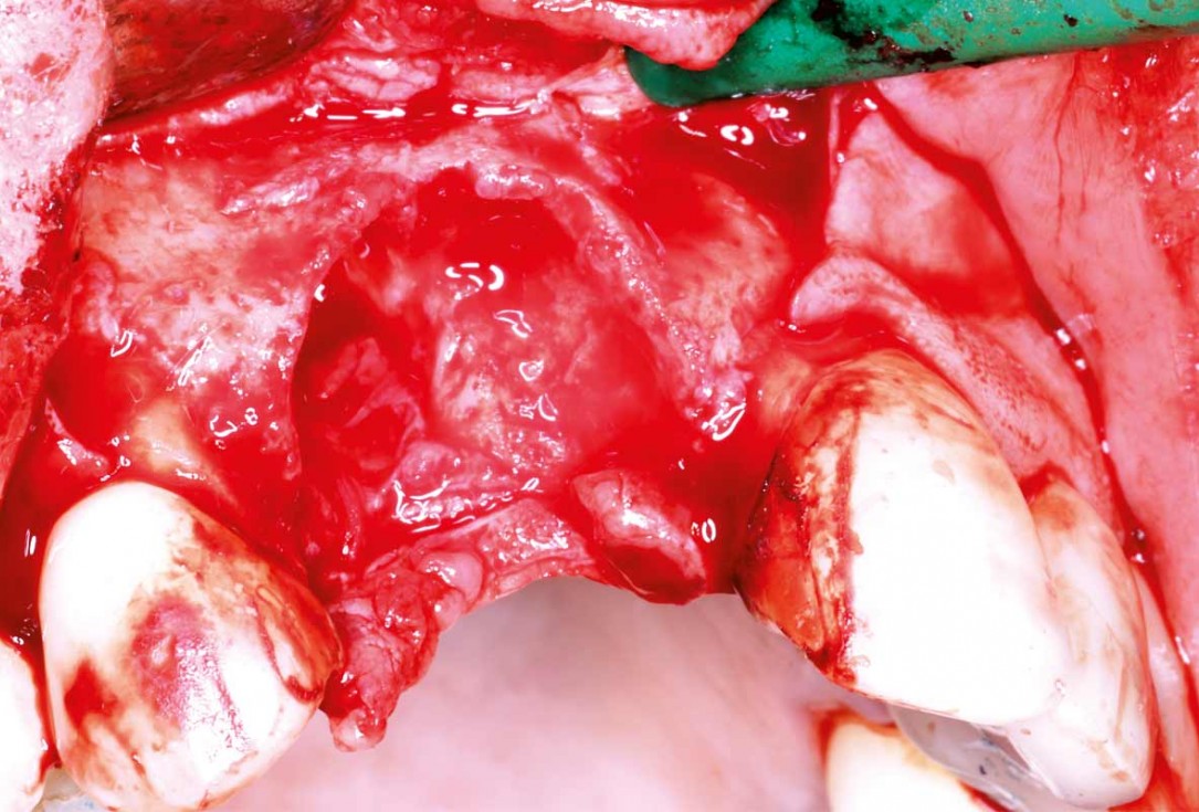 Maxillary bone reconstruction in the anterior area with cerabone and Jason membrane - Dr. P.-Y. Gegout & Prof. O. Huck