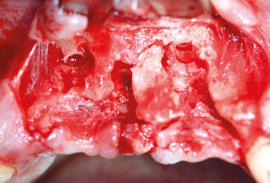 botiss maxgraft® bonebuilder aesthetic reconstruction - Clinical case