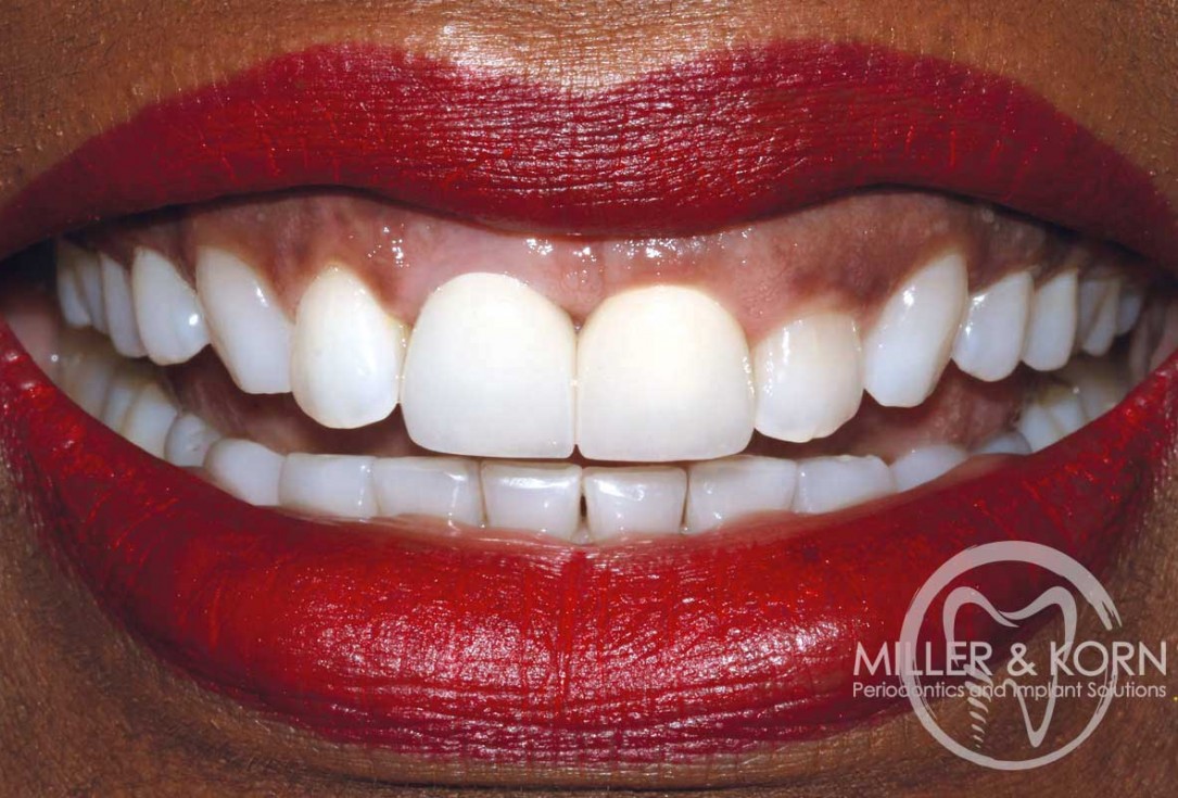 Immediate implant placement and regeneration of ridge using an allograft bone ring and Jason® membrane - Dr. Miller and Korn