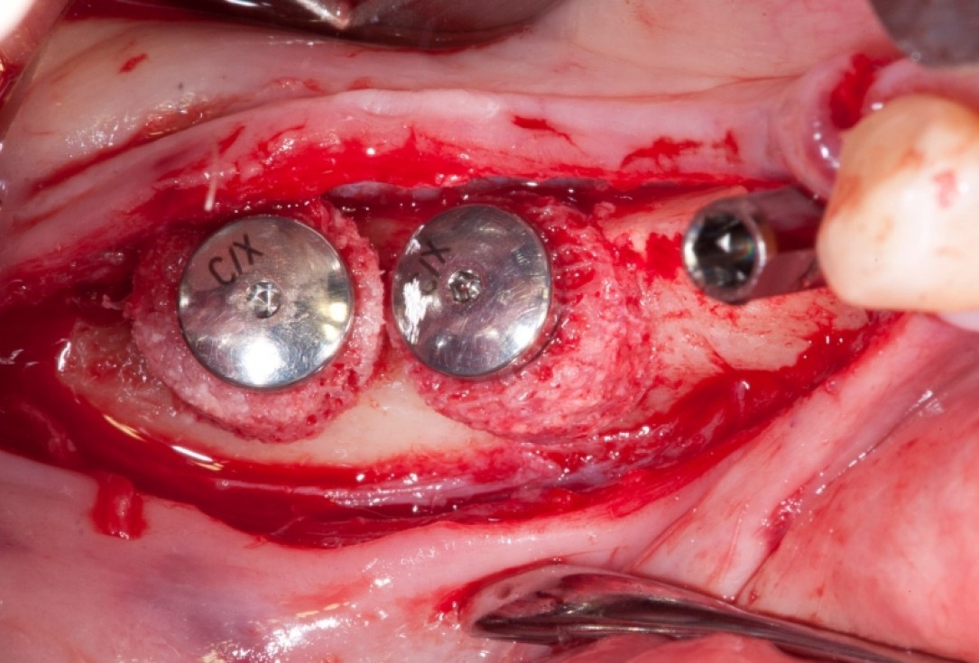 Vertical augmentation and sinus lift with maxgraft® bonering - Dr. O. Yüksel and Dr. B. Giesenhagen