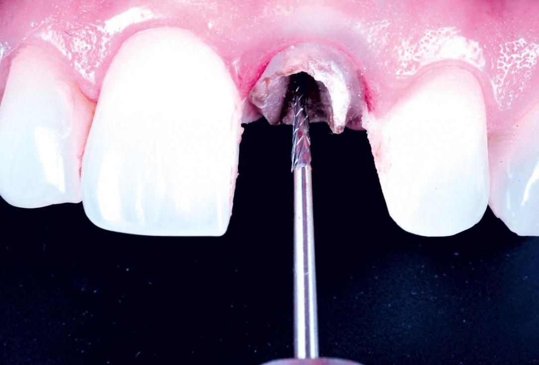 Excellent aesthetic result of buccal augmentation with mucoderm® and maxgraft® after immediate implant placement - 3-years follow-up - Dr. A. Puišys 
