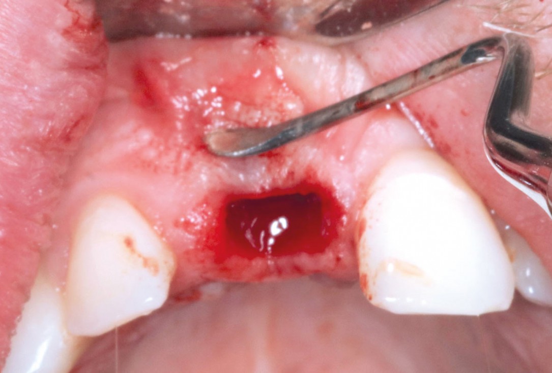 Type II socket defect grafted and repaired in a flapless way using Jason® membrane and maxgraft® cortico-cancellous - Dr. A. Jones