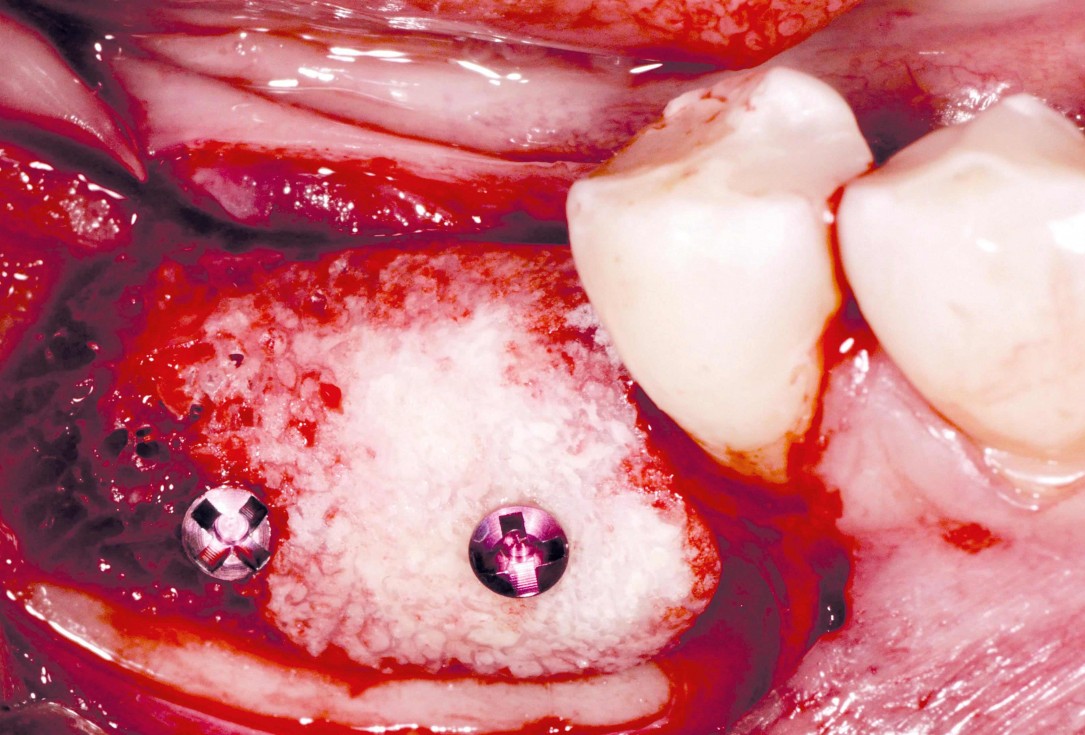 Ridge augmentation in the mandible with maxgraft® bonebuilder– Dr. R. Morger