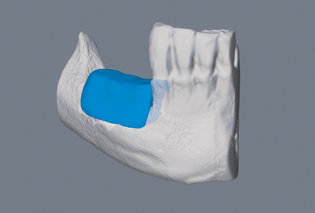 botiss maxgraft® bonebuilder for mandibular reconstruction - Clinical case
