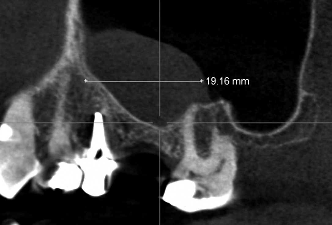 02/35 Maxillary sinus cyst removal using the Crocodile Technique and subsequent lateral sinus lift with cerabone®, maxgraft® and Jason® membrane - Dres. C. Scognamiglio and A. Perucchi