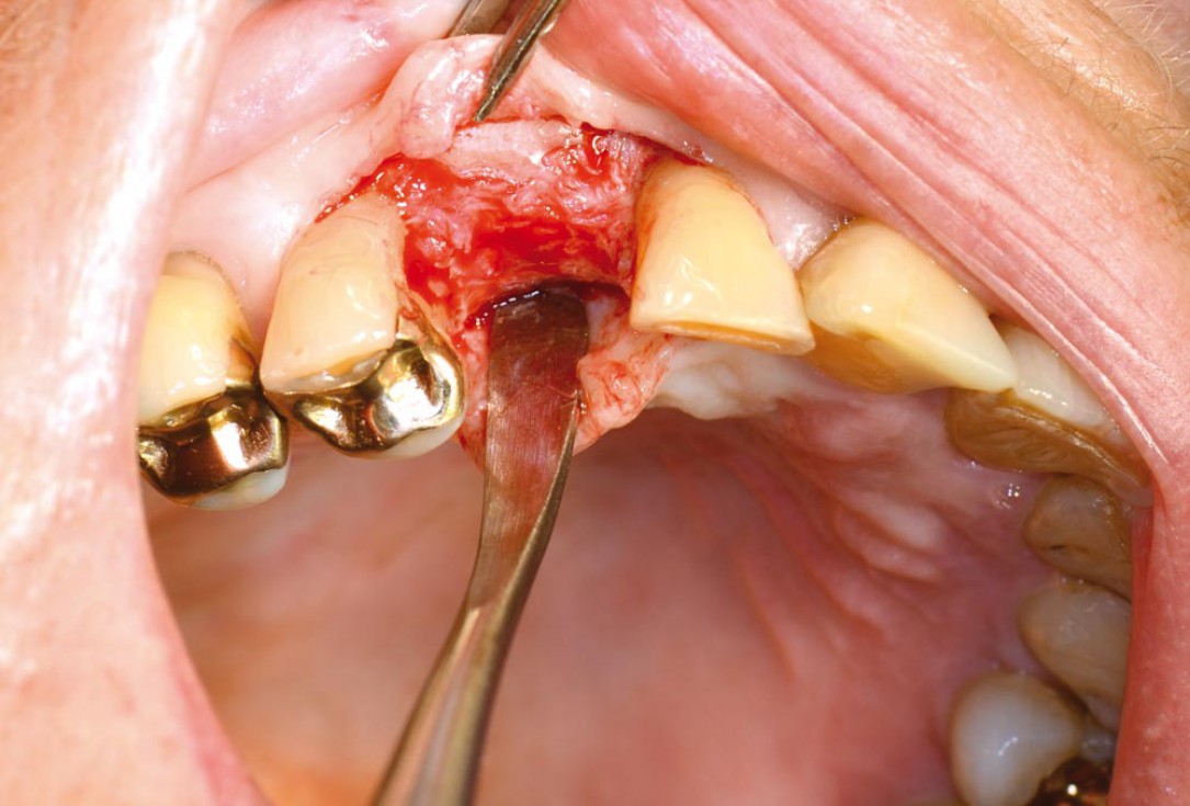 Block augmentation with maxgraft® in the maxilla - PD Dr. Dr. F. Kloss