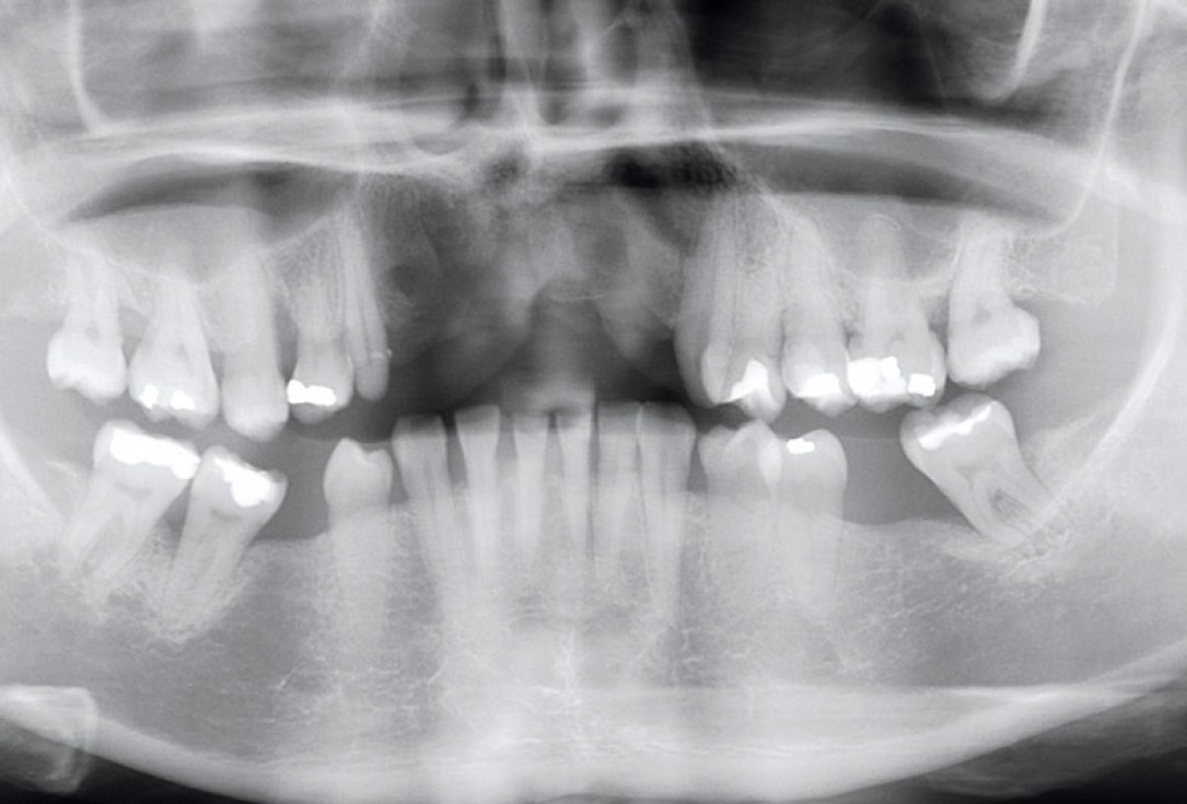 botiss maxgraft® bonebuilder aesthetic reconstruction - Clinical case
