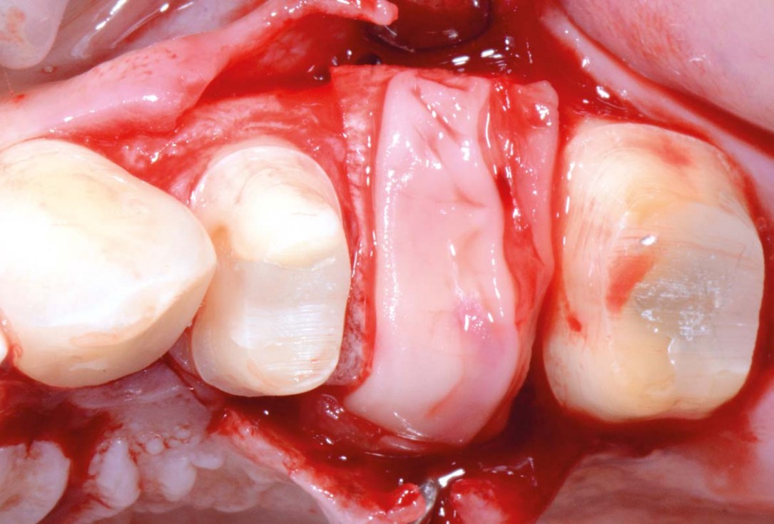 Full bone regeneration in extraction socket augmented with maxgraft® and Jason® membrane – Dr. C. Landsberg