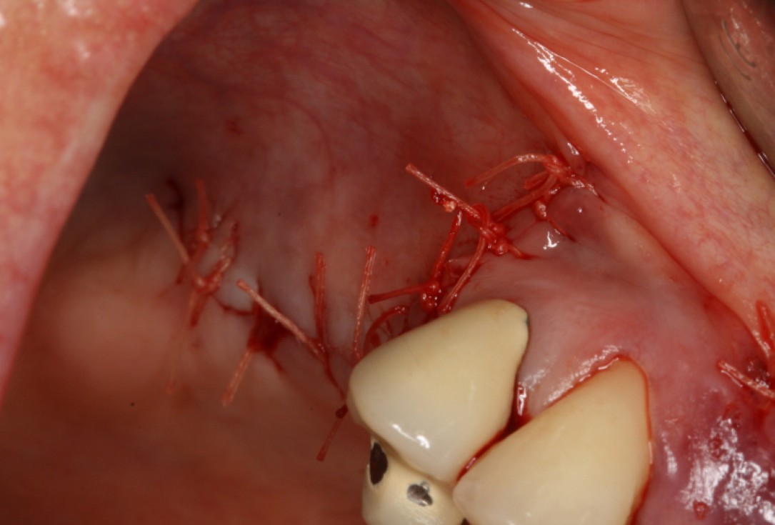 06/20 GBR with maxresorb® and Jason® membrane - Prof. Dr. Dr. D. Rothamel