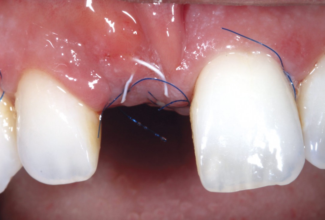 maxgraft® cortico at combined defect palatally and facially - Dr. K. Höckl