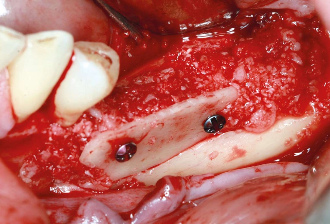 maxgraft® cortico at free-end situation in the mandible - J. Kielhorn