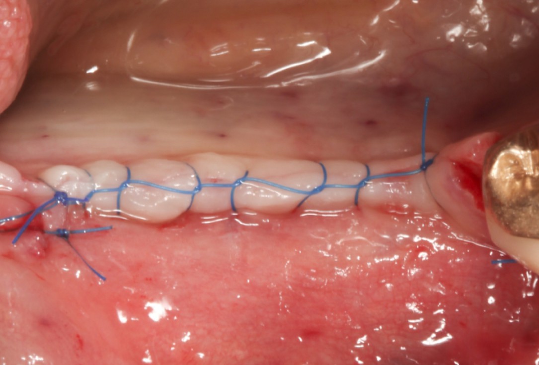 Ridge augmentation with maxgraft® bonebuilder - Dr. M. Jacotti