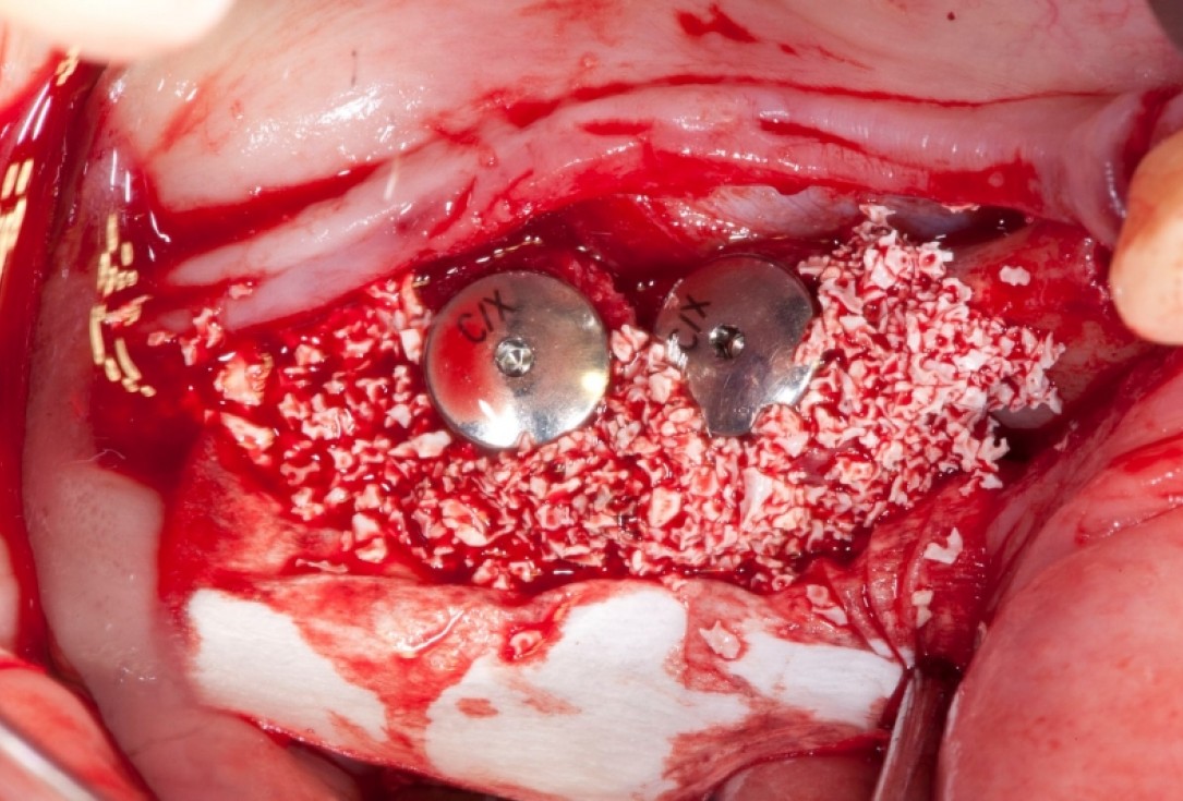 Vertical augmentation and sinus lift with maxgraft® bonering - Dr. O. Yüksel and Dr. B. Giesenhagen