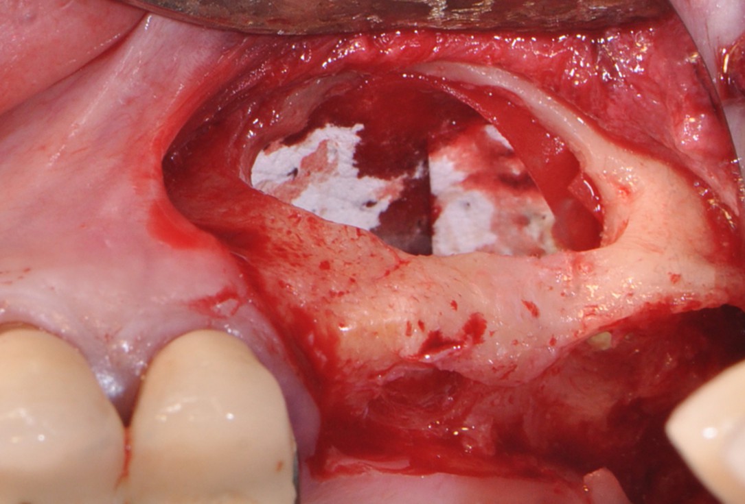 Sinus lift with simultaneous implantation with cerabone® and collprotect® membrane - clinical case Dr. Victor Kalenchuk