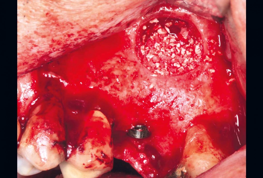 21/35 Maxillary sinus cyst removal using the Crocodile Technique and subsequent lateral sinus lift with cerabone®, maxgraft® and Jason® membrane - Dres. C. Scognamiglio and A. Perucchi